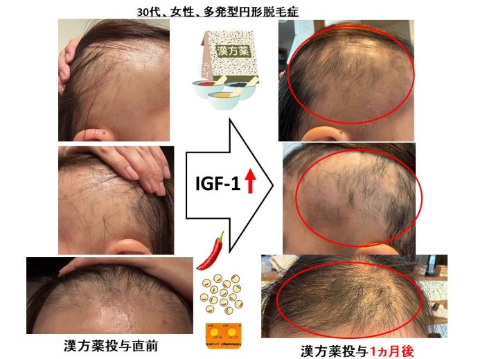 円形脱毛症　病院